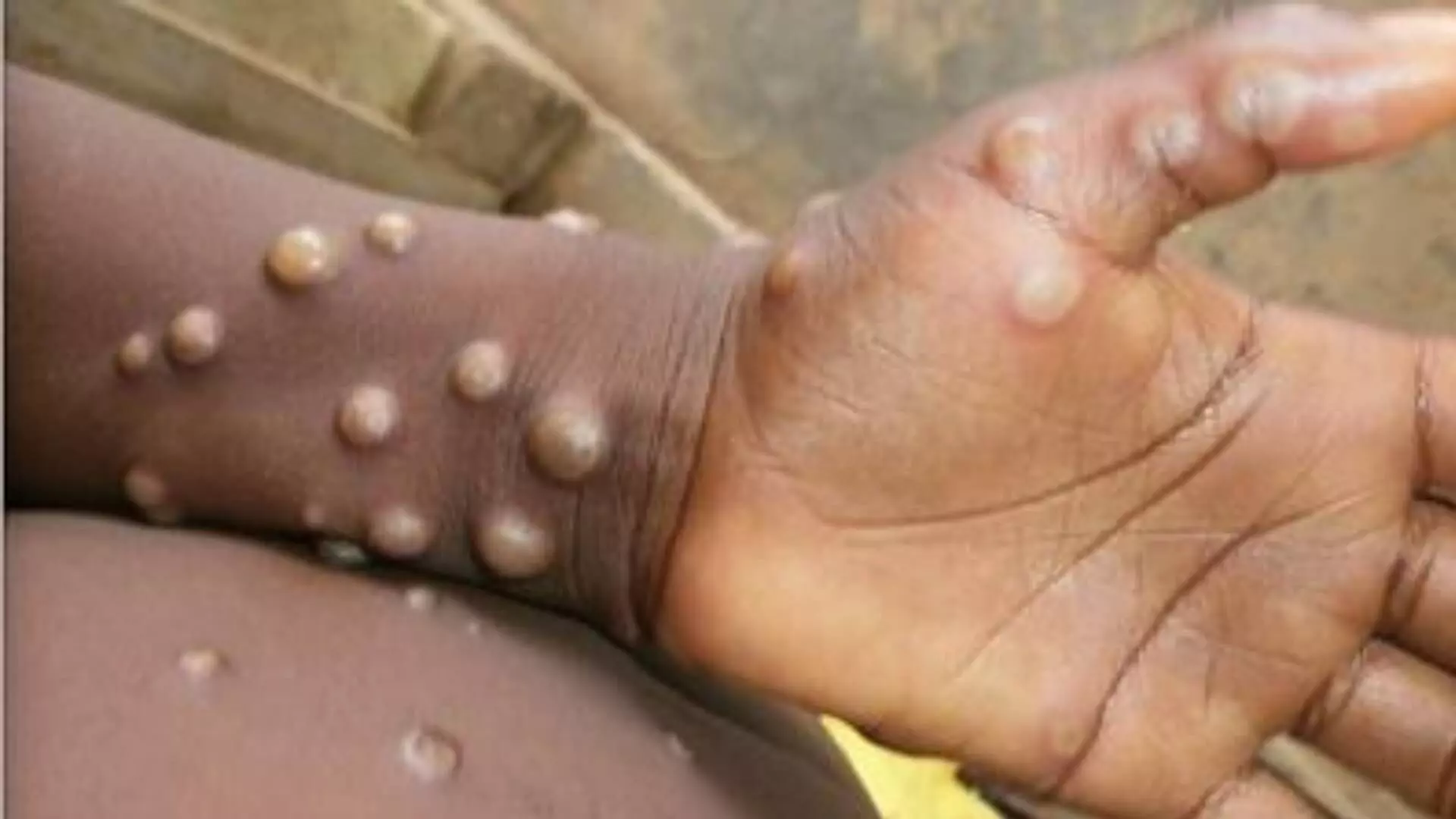 टेन्शन वाढले, आता Monkeypox च्या संसर्गाची भीती