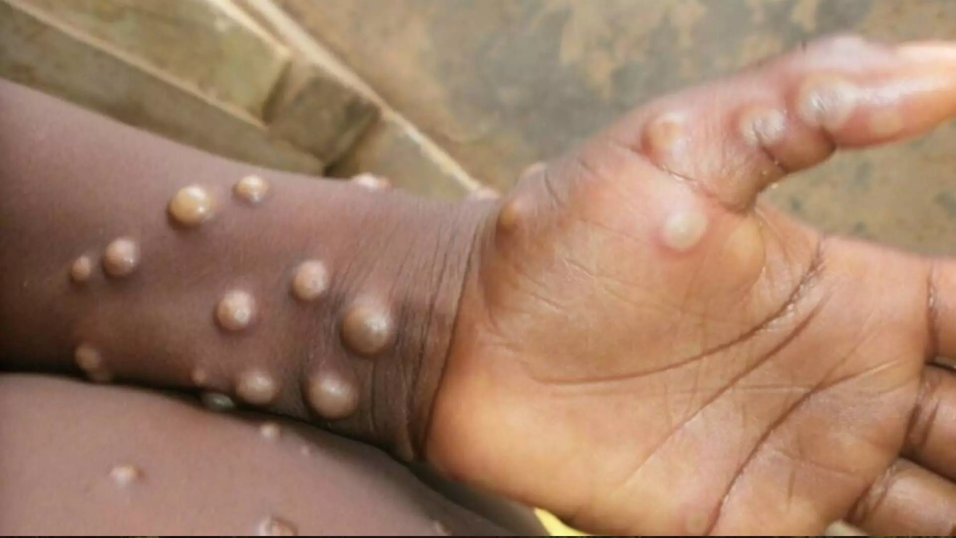 Monkeypox चे संकट किती गंभीर आहे? – डॉ. संग्राम पाटील