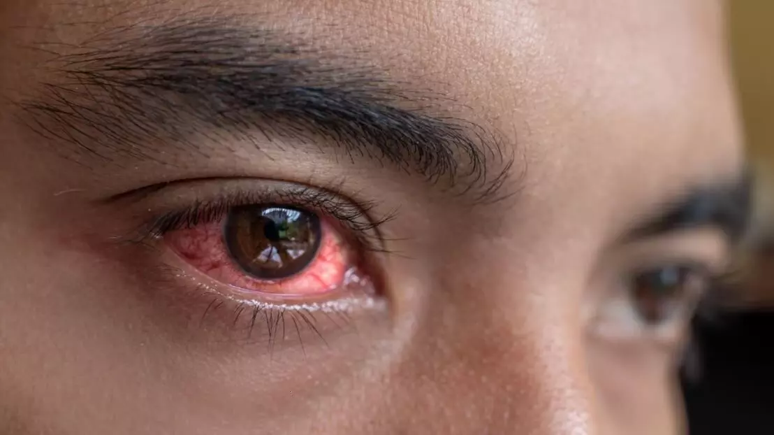 Eye Flu | राज्यात डोळ्यांची साथ ; विभागाकडून पथके तैनात-आरोग्यमंत्र्यांची माहिती