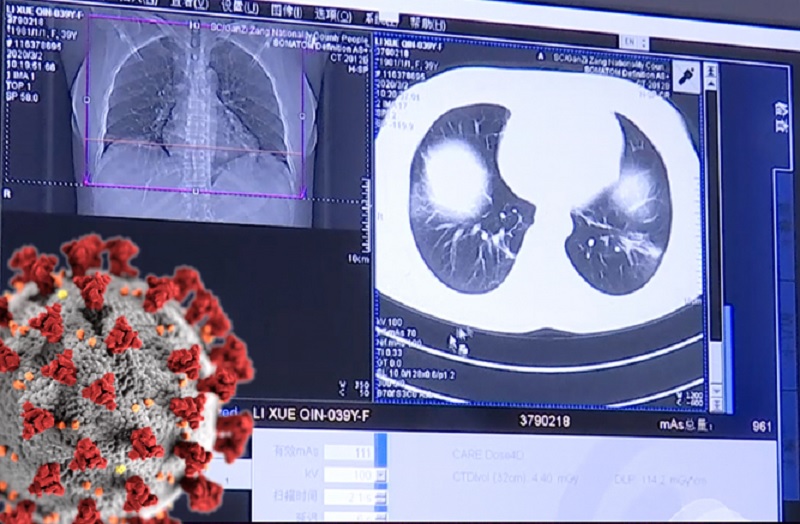 करोनामध्ये CT-scan गरजेचा आहे का ?